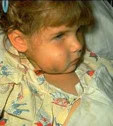 Swelling caused by Hib infection: Photo Courtesy of the Children's Immunization Project